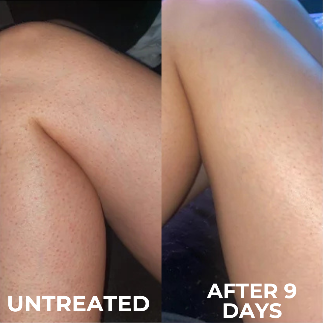 Smooth Skin Complex for Keratosis Pilaris