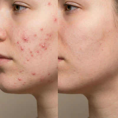 Elvior Acne Buster Spot Serum