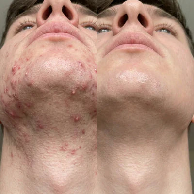 Elvior Acne Buster Spot Serum