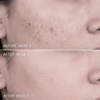Elvior Acne Buster Spot Serum