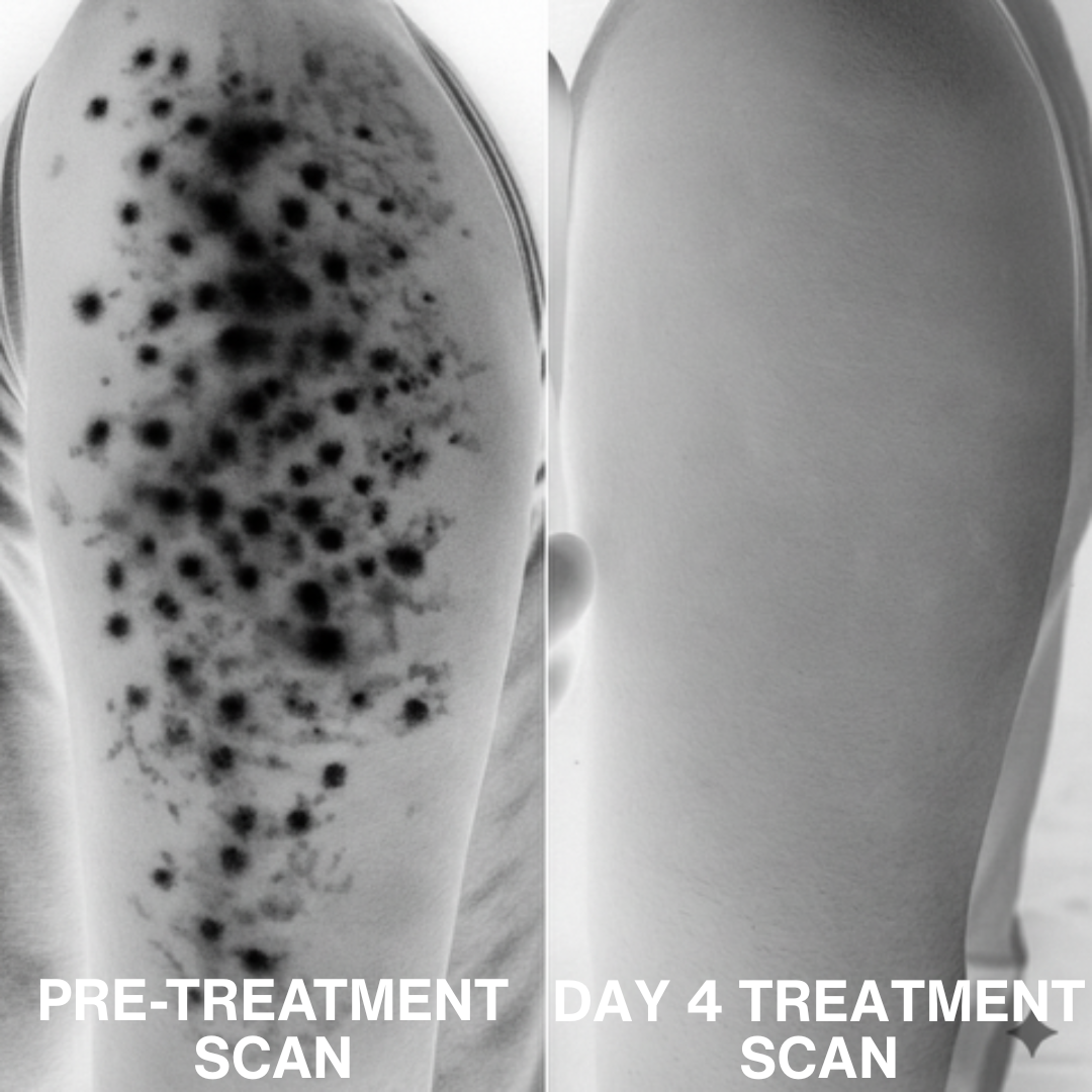 Smooth Skin Complex for Keratosis Pilaris