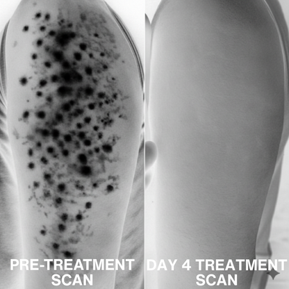 Smooth Skin Complex for Keratosis Pilaris