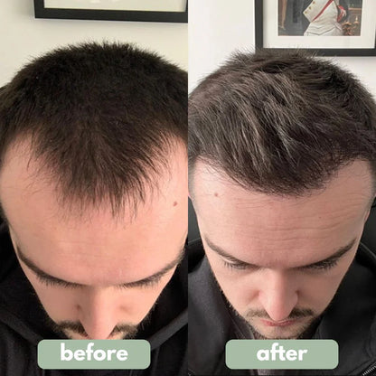 Elvior® Hair Growth Roll-On