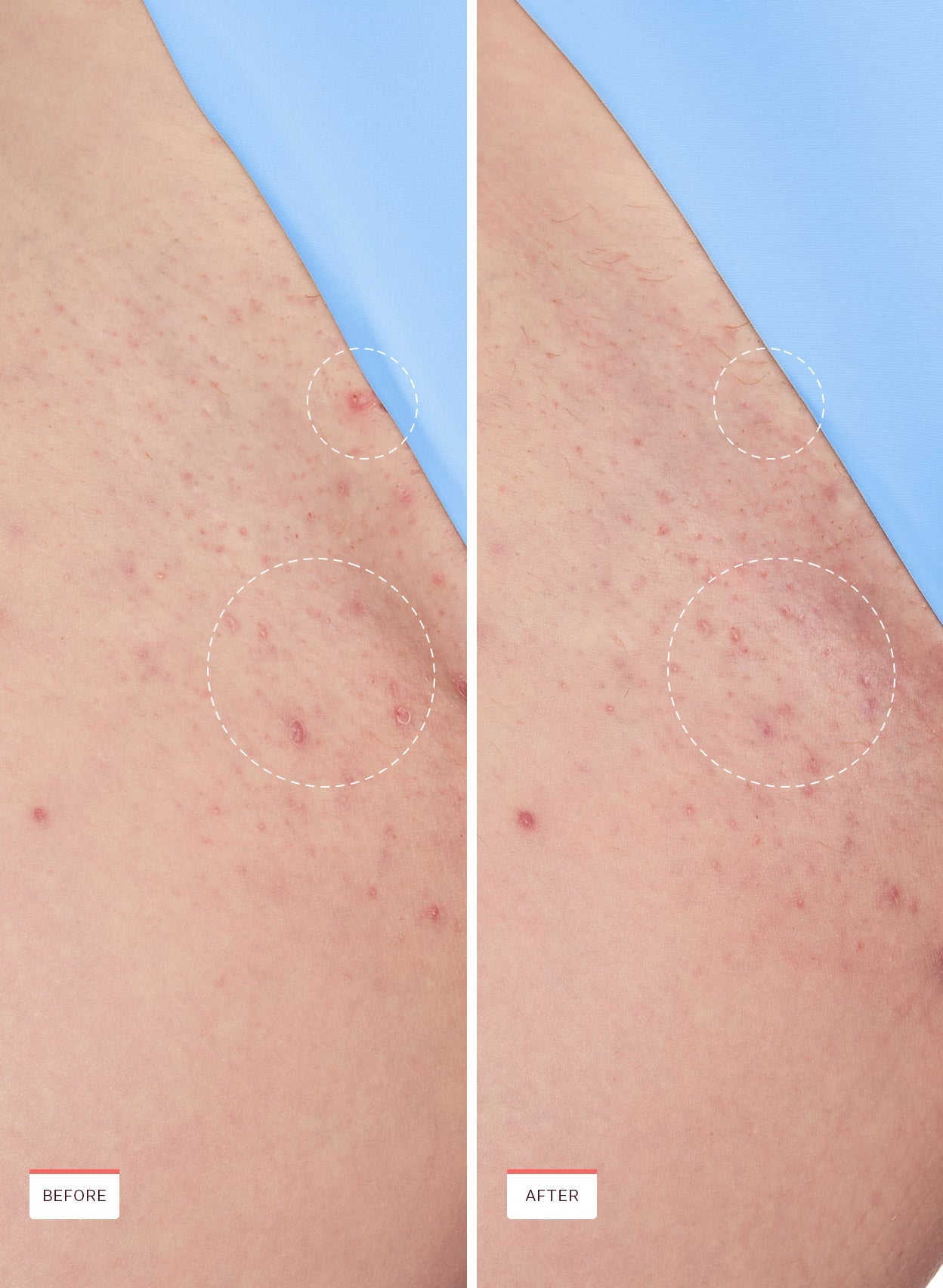 Ingrown Hair Smoothing Roller