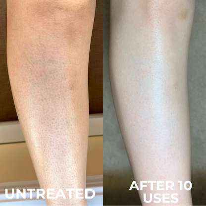 Smooth Skin Complex for Keratosis Pilaris