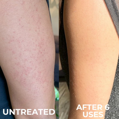 Smooth Skin Complex for Keratosis Pilaris