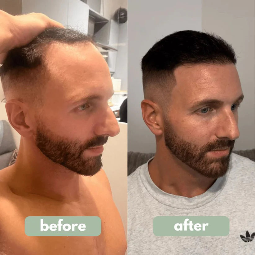 Elvior® Hair Growth Roll-On